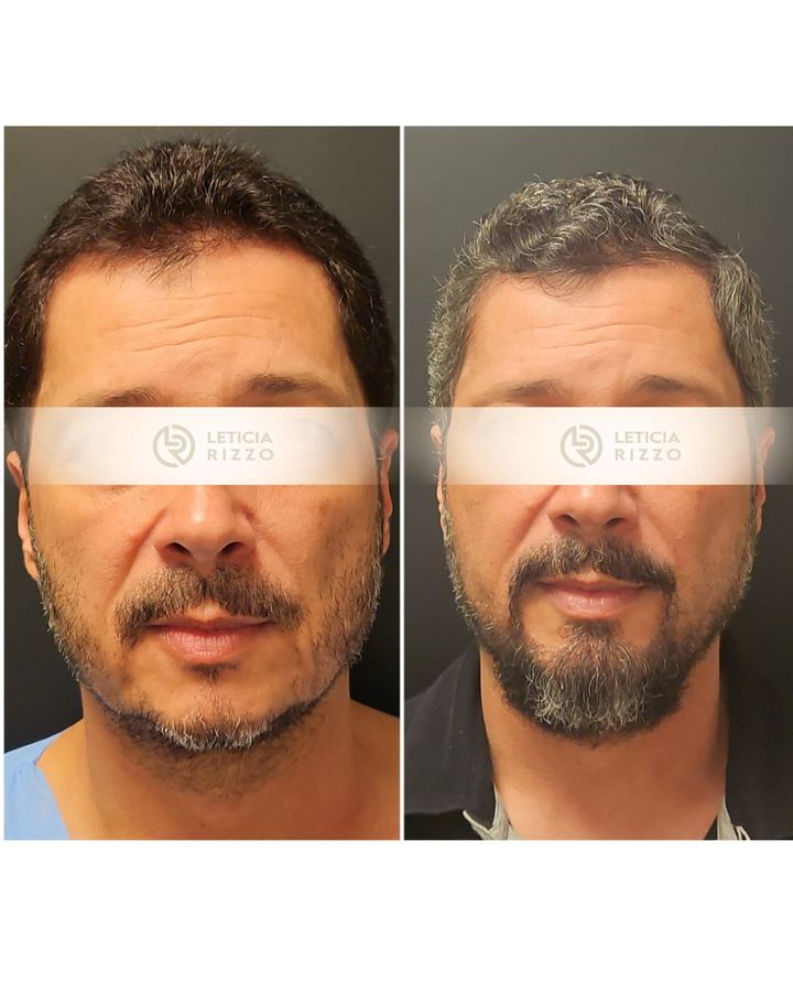Antes e depois de transplante de barba pela técnica FUE, paciente da Dra. Letícia Rizzo