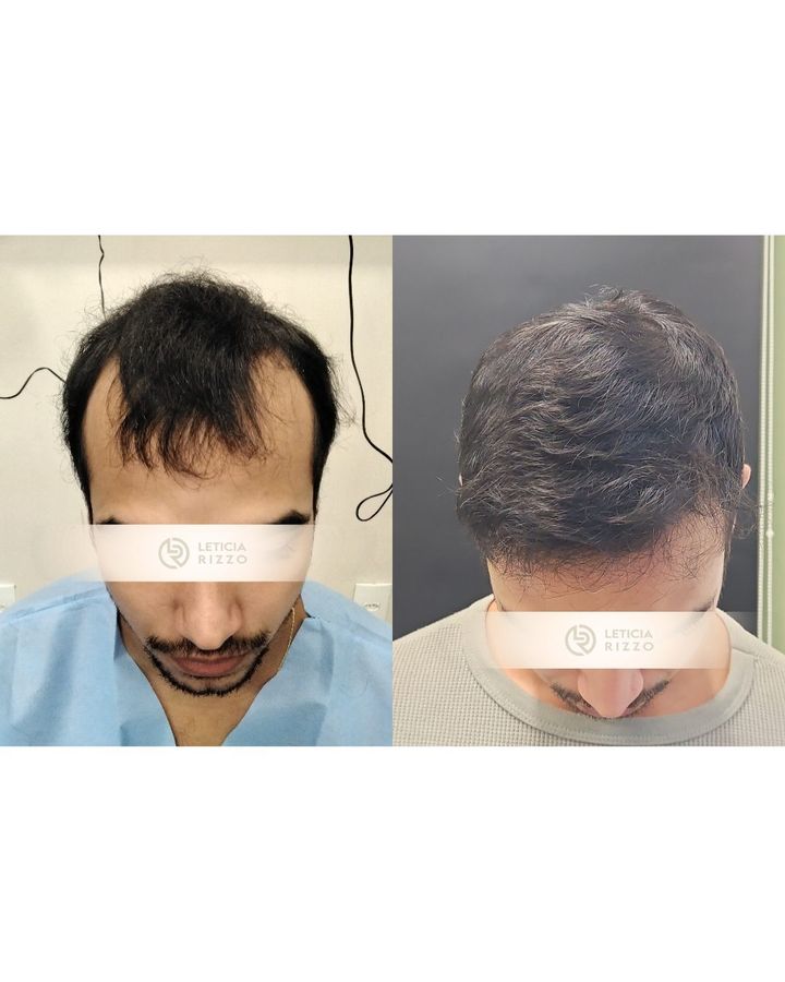 Antes e depois de transplante capilar FUE: aumento de densidade no topo, paciente da Dra. Letícia Rizzo