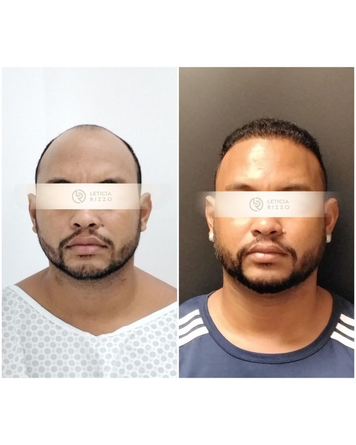 Antes e depois de transplante capilar FUE: cobertura de topo, paciente da Dra. Letícia Rizzo