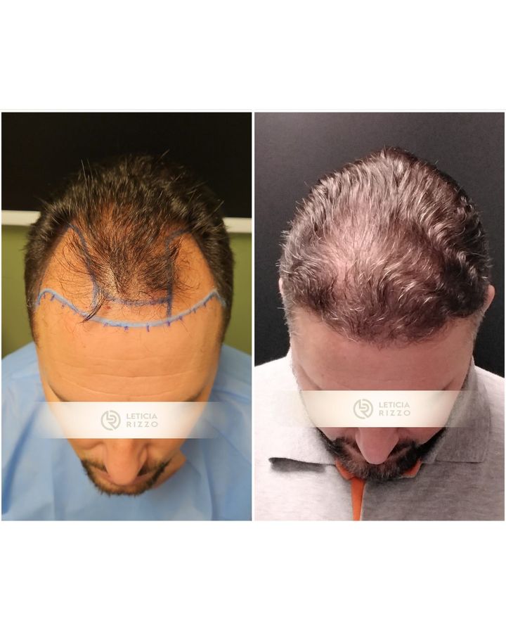 Antes e depois de transplante capilar FUE: reconstrução da linha frontal, paciente da Dra. Letícia Rizzo