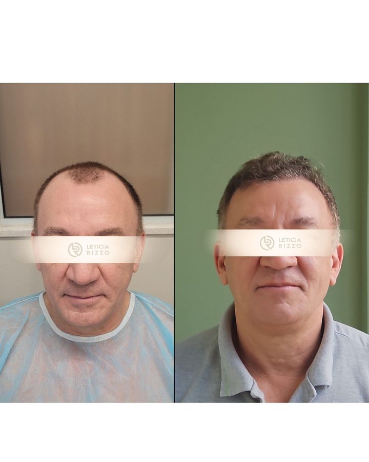 Antes e depois de transplante capilar FUE: nova linha frontal, paciente da Dra. Letícia Rizzo