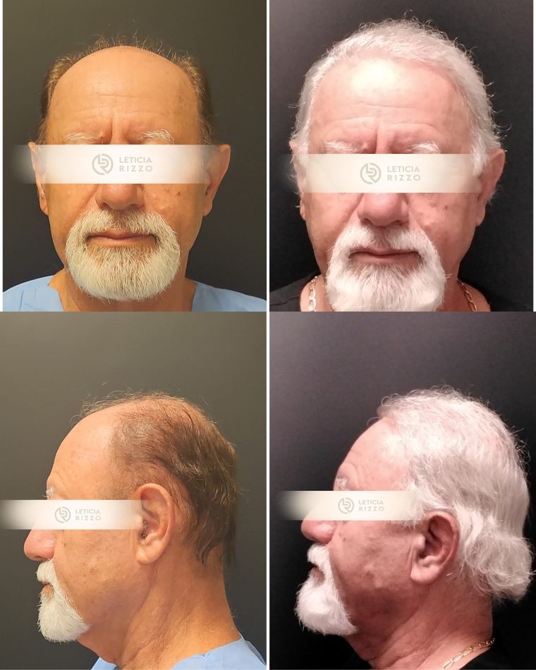Antes e depois de transplante capilar FUE em quatro ângulos: restauração completa, paciente da Dra. Letícia Rizzo