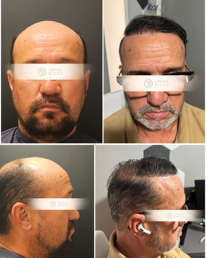 Antes e depois de transplante capilar FUE: topo e coroa em quatro ângulos, paciente da Dra. Letícia Rizzo